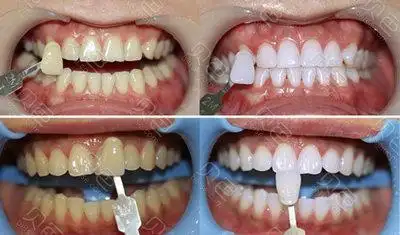 广州牙齿美白医院排名前几位,都是小姐姐推荐价格ok的地方!