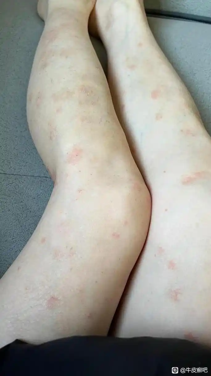 左右双腿都有牛皮癣,1个月以后,皮损消失不见了 究竟是怎么做到的