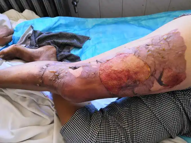 自配纯中药烫伤药治疗右下肢烫伤病例分享