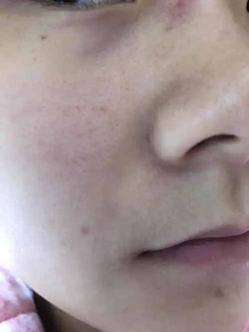 请问这些黑头闭口粉刺怎么去啊