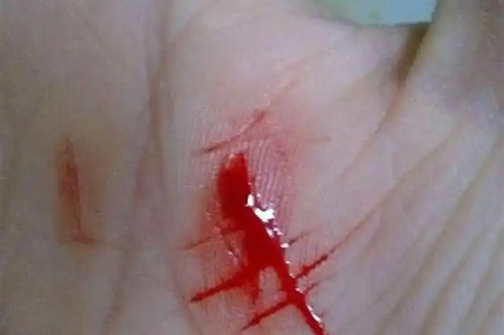 梦见手被别人砍伤流血