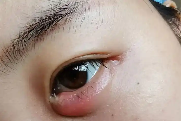 睑腺炎临床表现为眼睛下方皮肤局限性红肿,硬结和压痛,形成突出的红