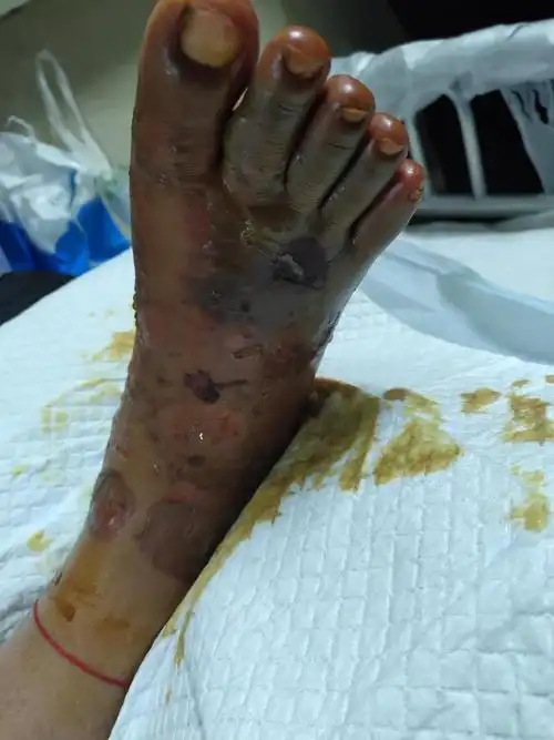 一个小女孩,脚部严重受伤,揪动着点滴公益,萤火虫和社会各界爱心人士