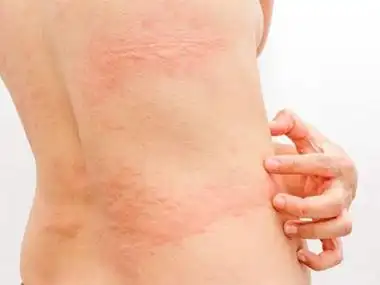 革螨皮炎背部起带状红色风团图