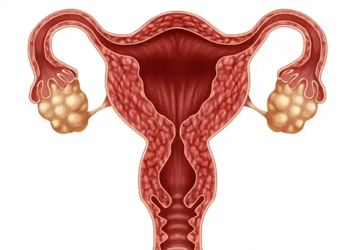 子宫肌瘤与子宫肉瘤,可不是一字之差