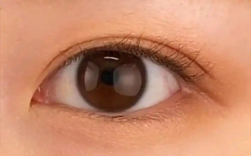 平行款双眼皮,七毫米左右