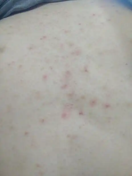 请问这是否是脂溢性皮炎?