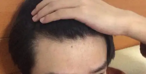 感觉鬓角稀疏,谢谢.