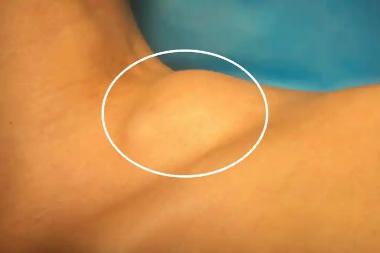 锁骨淋巴结肿大