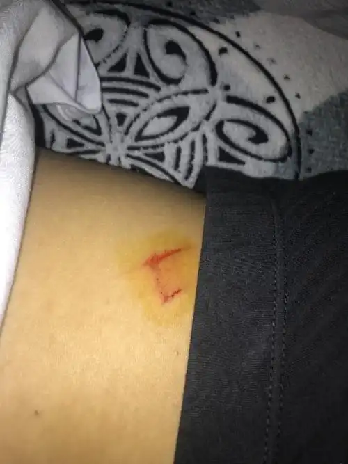 腰上面撞到桌子角涂了碘伏伤口还是在流血咋办碘伏也涂了几次