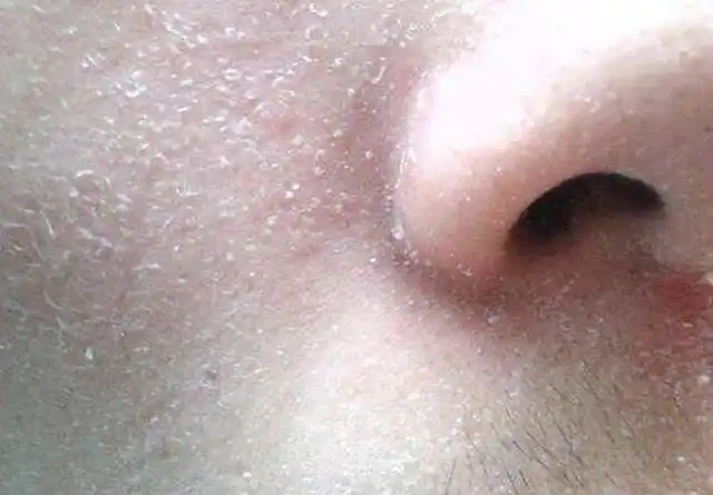 春季皮肤又干又痒还红怎么办医生教你3招轻松应对