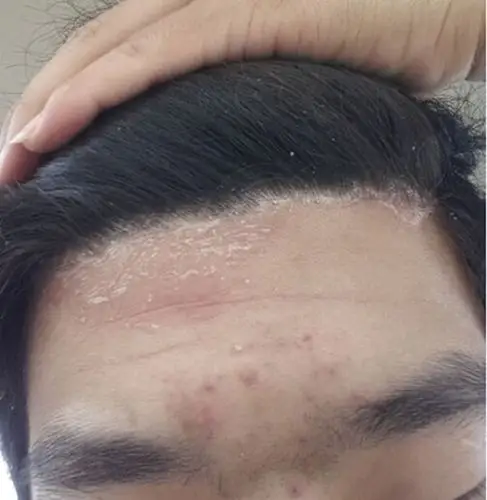 女生的头癣初期图片_有来医生