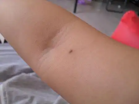 手臂痣的位置与命运手臂痣的痣相分析