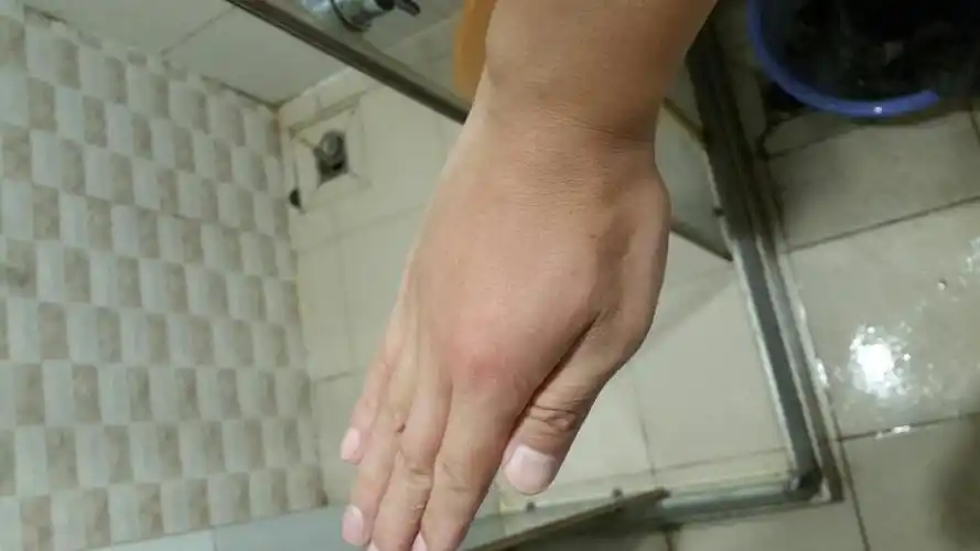 请问右手背浮肿,胀痒痛是怎么回事