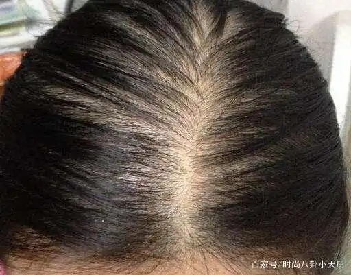 不到30岁就脱发,这几个原因千万不能忽视!说不定还能挽回