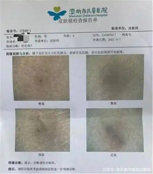 记者在检查报告中看到,男童的臀部,颈部,足部等部位出现多个针尖大小