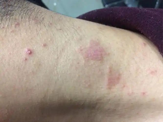 特应性皮炎具体是一种什么类型的皮肤病? - 知乎