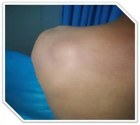 典型病例之脂肪瘤