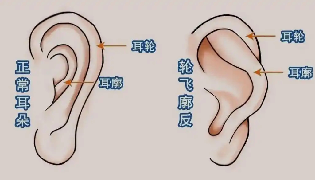 反骨耳又叫#轮飞廓反 - 抖音