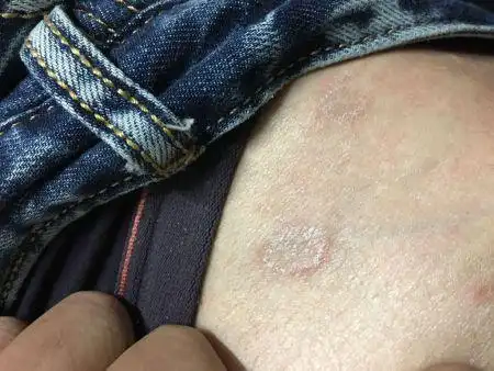 个多月 没有治疗  偶尔有些痒右腿正侧根部 有几个这样的圆形扁平的癣