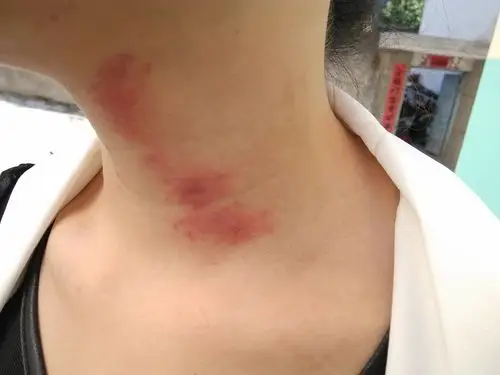 求助:老婆脖子到底怎么了 - 皮肤及性传播疾病讨论版 - 爱爱医医学