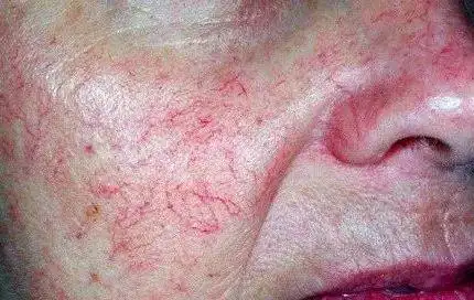 红血丝和敏感肌到底是不是一回事