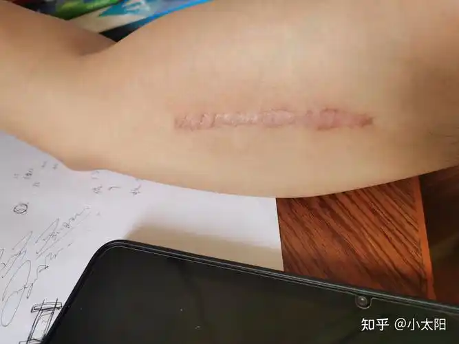 十厘米纹身切除后续