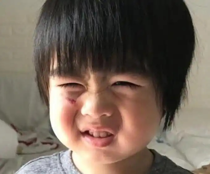 林志颖儿子跌伤脸 网友:是亲爸没错了摔伤还能很萌