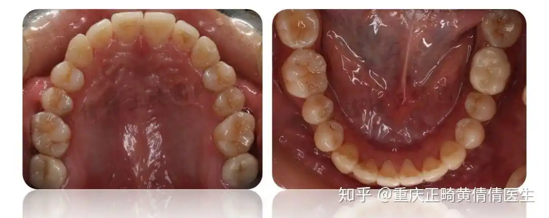 前突伴下颌第二磨牙缺失的隐形矫治病例 - 知乎