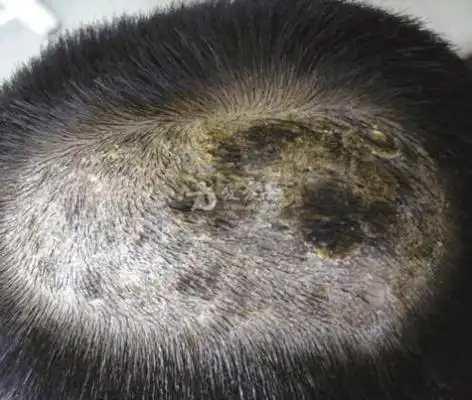 头癣图片_头癣症状表现图片大全_有来医生