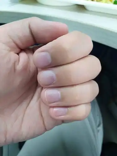 我这个属不属于心脏病变紫的指甲?