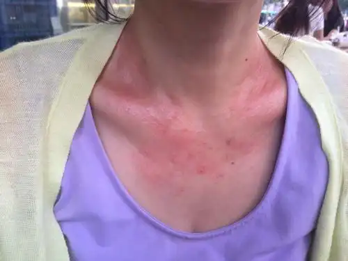 老婆从公园回来脖子老是痒红红的好几天了应该怎么办?
