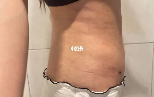 腰腹环吸18天_腰腹_环吸_减肥_减肥医药