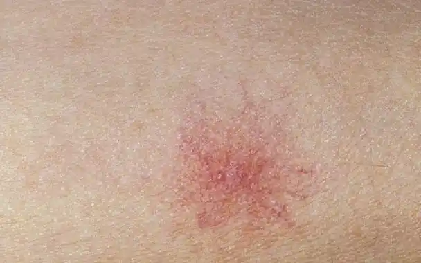 不是过敏,而是肝癌预警?皮肤出现3种异样时,小心肝毒"侵袭"