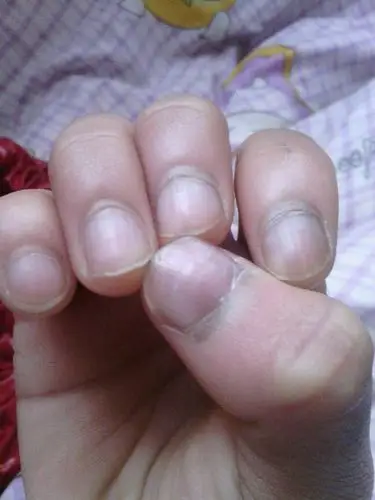 手指甲呈现紫色,中间还有一坚黑黑的.