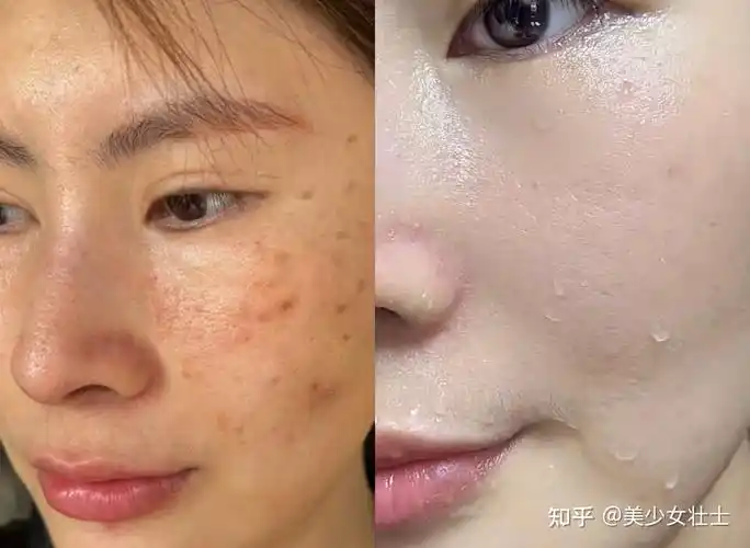 黑黄皮靠中科院博士研发的光甘草定美白敷料有用吗? - 知乎