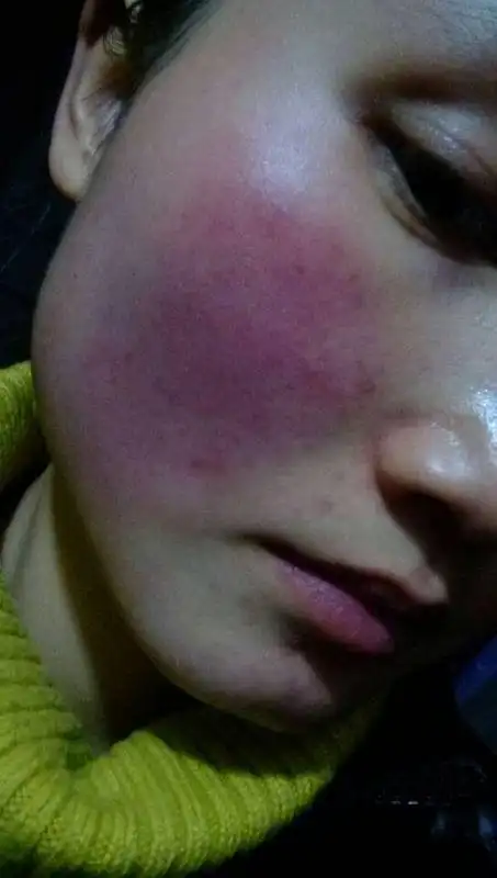 红血丝皮肤困扰几年了,看了不少医生,不知