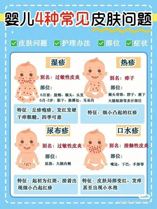 分辨宝宝各种疹湿疹or热疹