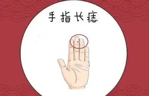 手指有痣01虽然黑色的痣有些令人讨厌,特别是对于女性而言更是更不得