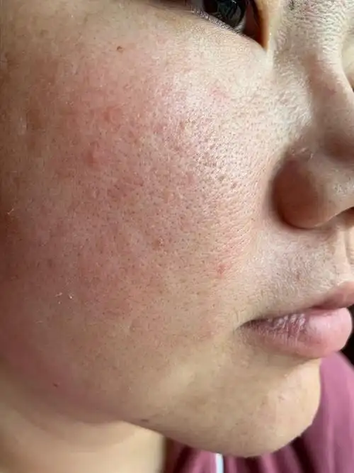 医生您好我现在的皮肤状态感觉皮薄粗糙敏感泛红脸颊