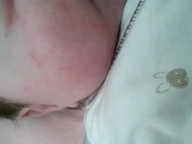 一个月不到的宝宝中午下午脸红红的一块 怎么了?