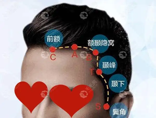 是在m型发际线之下鬓角之上.