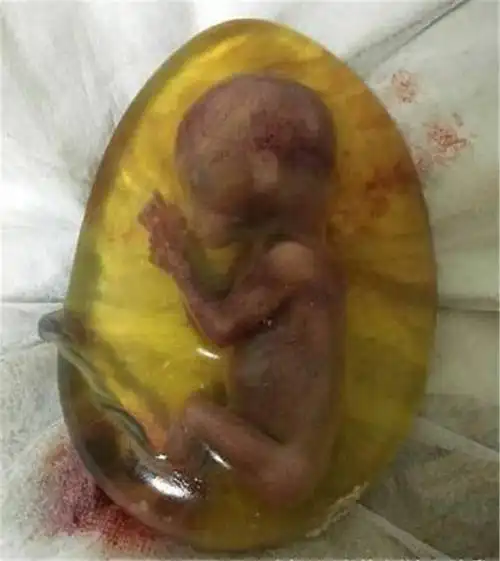 人工流产原来是这样解决孩子的,宝宝好无辜,好心痛!