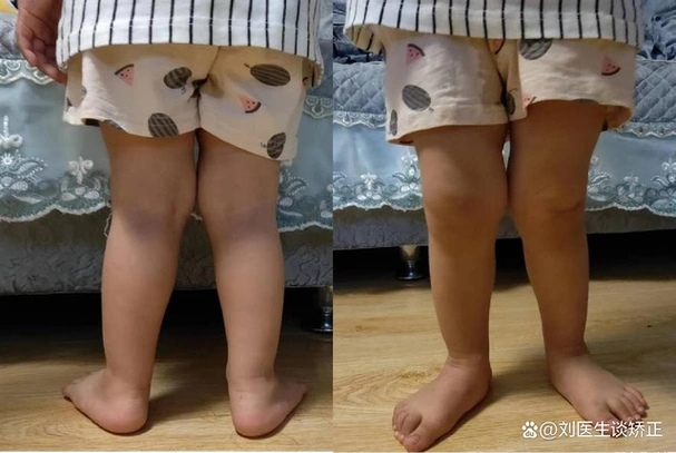 足外翻合并膝外翻(又称为x型腿),是儿童常见的下肢问题.