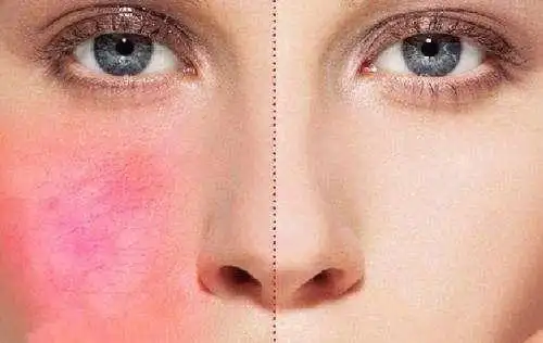 2020年夏天来了,敏感肌肤要如何自救? - 时尚 - 大众新闻网—大众生活