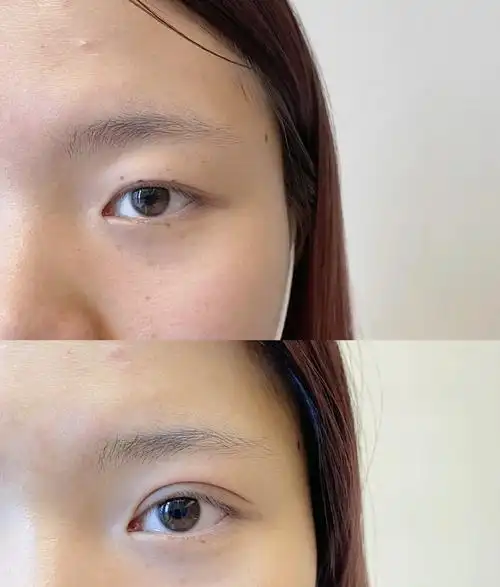 埋线会双眼皮案例