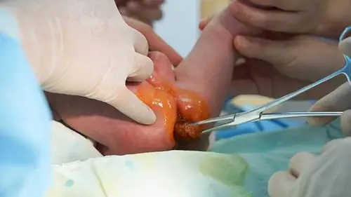 肛肠科年龄最小患者康复出院宝宝花式露笑萌化了