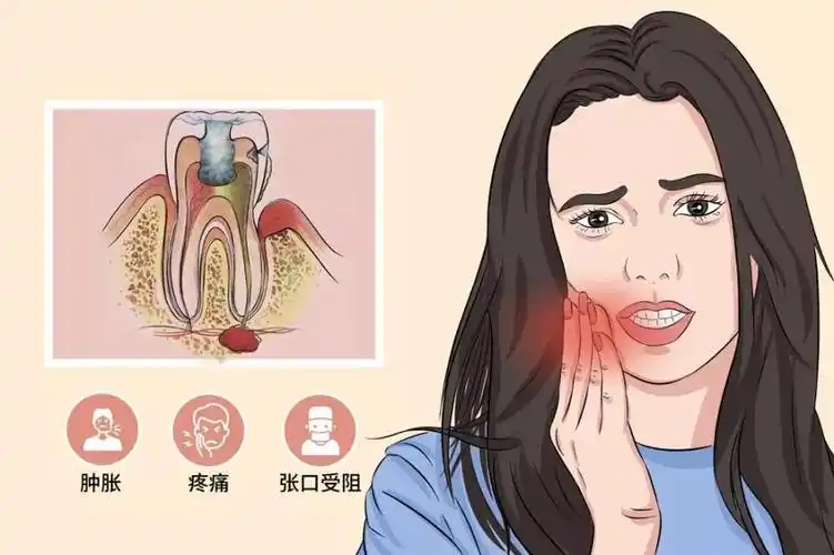 得了智齿冠周炎怎么办口腔科医生来帮您