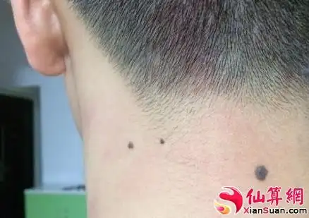 脖子上长痣好不好?