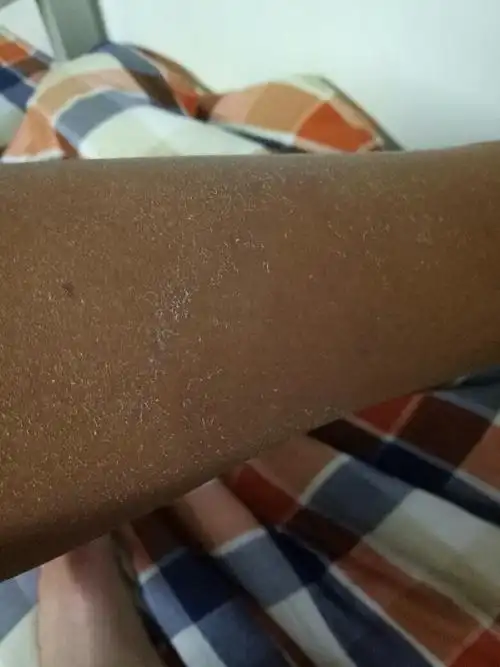 手臂上起了死皮这是怎么回事